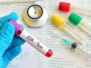 تفسیر آزمایش ESR