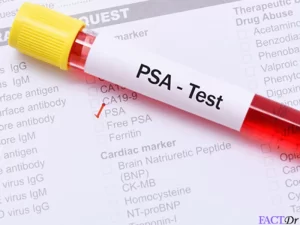 آزمایش پروستات